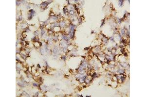 IHC-P: N-Cadherin antibody testing of human ovary cancer tissue (N-Cadherin anticorps  (AA 701-714))