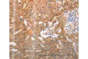 Immunohistochemistry of Human ovarian cancer using NQO1 Polyclonal Antibody at dilution of 1:25 (NQO1 anticorps)