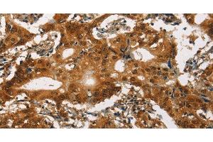 Immunohistochemistry of paraffin-embedded Human gasrtic cancer tissue using Cav1.