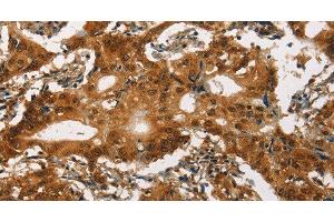 Immunohistochemistry of paraffin-embedded Human gasrtic cancer tissue using Cav1. (CACNA1C anticorps)