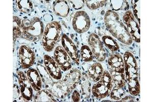 Immunohistochemical staining of paraffin-embedded Carcinoma of liver tissue using anti-LIPG mouse monoclonal antibody. (LIPG anticorps)