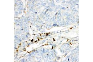 Anti- HEXB antibody, IHC(P): Human Lung Cancer Tissue (HEXB anticorps  (AA 381-556))