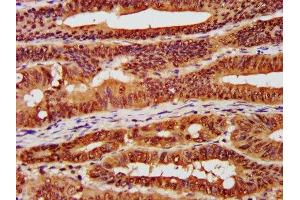 IHC image of ABIN7146885 diluted at 1:300 and staining in paraffin-embedded human colon cancer performed on a Leica BondTM system.