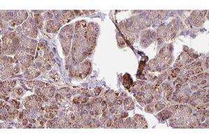 ABIN6273291 at 1/100 staining Human pancreas cancer tissue by IHC-P.