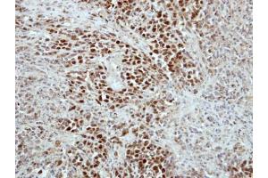 IHC-P Image Immunohistochemical analysis of paraffin-embedded SCM1 xenograft, using RAP1, antibody at 1:500 dilution.