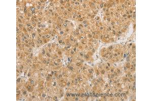 Immunohistochemistry of Human liver cancer using PGK2 Polyclonal Antibody at dilution of 1:50