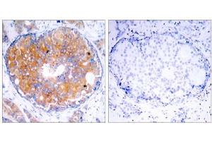 Immunohistochemical analysis of paraffin-embedded human breast carcinoma tissue using MEK2 (Ab-394) antibody (E021008). (MEK2 anticorps)