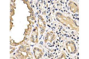 Immunohistochemistry of paraffin-embedded Human kidney cancer using ARRB2 Polyclonal Antibody at dilution of 1:200 (40x lens). (Arrestin 3 anticorps)
