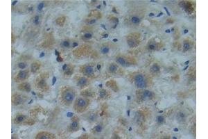 Detection of SMAD9 in Human Liver cancer Tissue using Polyclonal Antibody to SMAD family member 9 (SMAD9)