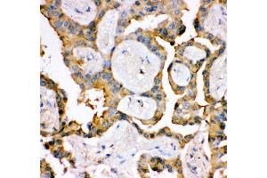 Anti- IRS1 antibody, IHC(P) IHC(P): Human Lung Cancer Tissue