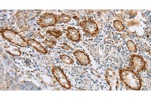Immunohistochemistry of paraffin-embedded Human lung cancer tissue using CD108 Polyclonal Antibody at dilution 1:35 (SEMA7A anticorps)