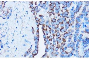 Immunohistochemistry of paraffin-embedded Human thyroid cancer using DDIT3 / CHOP Polyclonal Antibody at dilution of 1:100 (40x lens). (DDIT3 anticorps)