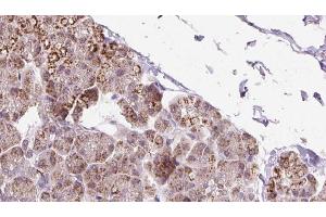 ABIN6273239 at 1/100 staining Human pancreas cancer tissue by IHC-P. (ETFDH anticorps  (C-Term))