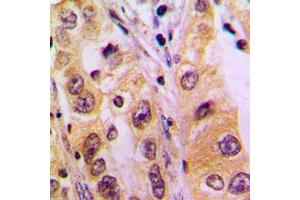 Immunohistochemical analysis of SURF1 staining in human liver cancer formalin fixed paraffin embedded tissue section.