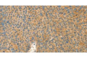 Immunohistochemistry of paraffin-embedded Human liver cancer tissue using AANAT Polyclonal Antibody at dilution 1:40 (AANAT anticorps)