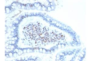Formalin-fixed, paraffin-embedded human Colon Carcinoma stained with BMI1-Monospecific Mouse Monoclonal Antibody (BMI1/2689).