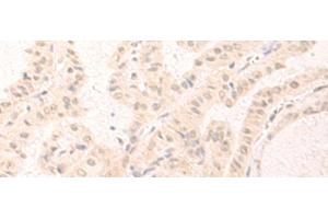 Immunohistochemistry of paraffin-embedded Human thyroid cancer tissue using IL7 Polyclonal Antibody at dilution of 1:30(x200) (IL-7 anticorps)