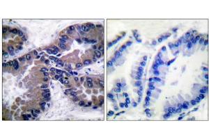 Immunohistochemical analysis of paraffin-embedded human lung carcinoma tissue, using NFE2L2 antibody (ABIN5976469). (NRF2 anticorps  (C-Term))