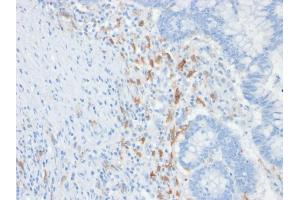 Formalin-fixed, paraffin-embedded human Colon Carcinoma stained with CD209 Mouse Monoclonal Antibody (C209/1781). (DC-SIGN/CD209 anticorps)
