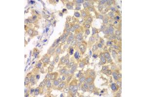 Immunohistochemistry of paraffin-embedded human esophageal cancer using PFKM antibody (ABIN5973190) at dilution of 1/100 (40x lens). (PFKM anticorps)