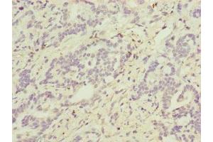 Immunohistochemistry of paraffin-embedded human lung cancer using ABIN7144847 at dilution of 1:100 (ATP5F1D anticorps  (AA 1-168))