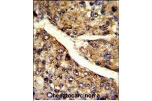 Formalin-fixed and paraffin-embedded human hepatocarcinoma reacted with FMO3 Antibody (N-term), which was peroxidase-conjugated to the secondary antibody, followed by DAB staining.