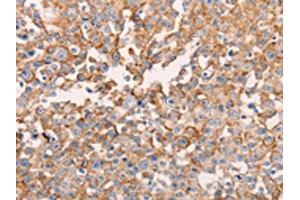 The image on the left is immunohistochemistry of paraffin-embedded Human breast cancer tissue using ABIN7129618(GNA11 Antibody) at dilution 1/40, on the right is treated with fusion protein. (GNA11 anticorps)