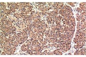 Immunohistochemistry of paraffin-embedded Human pancreas carcinoma tissue using CHOP Monoclonal Antibody at dilution of 1:200. (DDIT3 anticorps)
