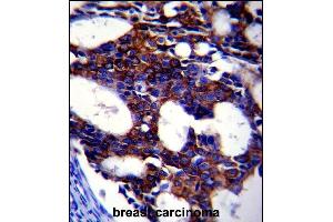TGFB2 Antibody (ABIN659106 and ABIN2838086) immunohistochemistry analysis in formalin fixed and paraffin embedded human breast carcinoma followed by peroxidase conjμgation of the secondary antibody and DAB staining. (TGFB2 anticorps)
