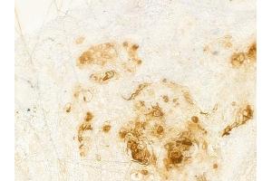 ABIN6259785 and ABIN6279088 at 1/100 staining human esophageal carcinoma by IHC-P.