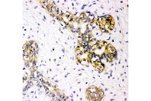 Anti-Tuberin Picoband antibody,  IHC(P): Human Mammary Cancer Tissue