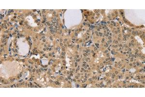 Immunohistochemistry of paraffin-embedded Human thyroid cancer using CENPV Polyclonal Antibody at dilution of 1:40