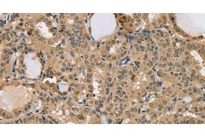 Immunohistochemistry of paraffin-embedded Human thyroid cancer using CENPV Polyclonal Antibody at dilution of 1:40 (CENPV anticorps)