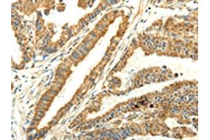 The image on the left is immunohistochemistry of paraffin-embedded Human esophagus cancer tissue using ABIN7128060(UBL4B Antibody) at dilution 1/25, on the right is treated with fusion protein. (UBL4B anticorps)