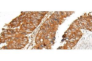 Immunohistochemistry of paraffin-embedded Human colorectal cancer tissue using MBOAT4 Polyclonal Antibody at dilution of 1:30(x200) (MBOAT4 anticorps)