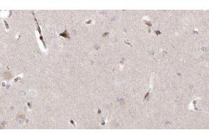 ABIN6273005 at 1/100 staining Human brain cancer tissue by IHC-P. (MAGT1 anticorps  (Internal Region))