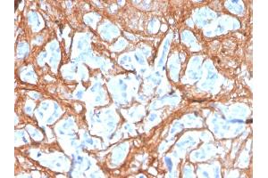 Formalin-fixed, paraffin-embedded human colon carcinoma stained with Periostin (POSTN) Mouse Monoclonal Antibody (POSTN/3503).