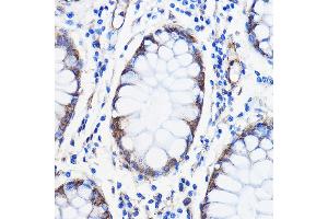 Immunohistochemistry of paraffin-embedded Human colon carcinoma using /// Rabbit pAb (ABIN7265627) at dilution of 1:50 (40x lens). (ANT1+ANT2+ANT3+ANT4 (C-Term) anticorps)