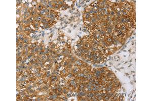 Immunohistochemistry of Human breast cancer using TPD52L2 Polyclonal Antibody at dilution of 1:35 (TPD52L2 anticorps)