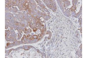 IHC-P Image Immunohistochemical analysis of paraffin-embedded N87 xenograft, using MAPK9, antibody at 1:100 dilution. (JNK2 anticorps)