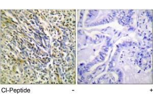 Immunohistochemical analysis of paraffin-embedded human lung carcinoma tissue using ACAN polyclonal antibody . (Aggrecan anticorps  (AA 336-369))