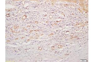 Formalin-fixed and paraffin embedded human liver carcinoma labeled with Rabbit Anti-CD4 Polyclonal Antibody, Unconjugated  at 1:200 followed by conjugation to the secondary antibody and DAB staining