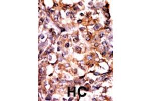Formalin-fixed and paraffin-embedded human cancer tissue reacted with the primary antibody, which was peroxidase-conjugated to the secondary antibody, followed by AEC staining. (MAPKAP Kinase 2 anticorps  (pSer272))