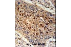 C4orf31 Antibody (N-term) (ABIN651996 and ABIN2840488) immunohistochemistry analysis in formalin fixed and paraffin embedded human lung carcinoma followed by peroxidase conjugation of the secondary antibody and DAB staining. (NDNF anticorps  (AA 80-109))