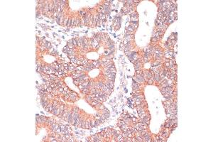 Immunohistochemistry of paraffin-embedded human colon carcinoma using TI antibody (ABIN6130725, ABIN6149146, ABIN6149147 and ABIN6214431) at dilution of 1:100 (40x lens). (TIAM1 anticorps  (AA 1392-1591))