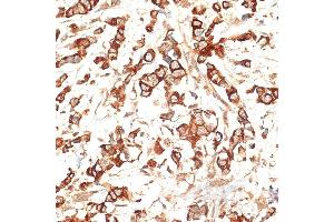 Immunohistochemistry of paraffin-embedded human breast cancer using Cytokeratin 13 (Cytokeratin 13 (KRT13)) antibody (ABIN7268090) at dilution of 1:100 (40x lens).