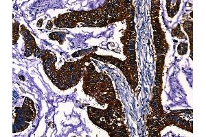 ABIN7094633 and ABIN7098683 at 1/100 staining Human liver cancer by IHC-P. (PGAM2 anticorps  (Internal Region))