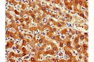 Immunohistochemistry of paraffin-embedded human liver cancer using ABIN7152571 at dilution of 1:100