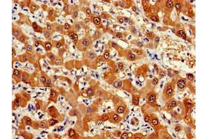 Immunohistochemistry of paraffin-embedded human liver cancer using ABIN7152571 at dilution of 1:100 (FDPS anticorps  (AA 1-419))