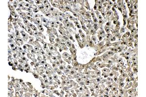 IHC analysis of GST3 / GST pi using anti-GST3 / GST pi antibody . (GSTP1 anticorps  (AA 2-210))